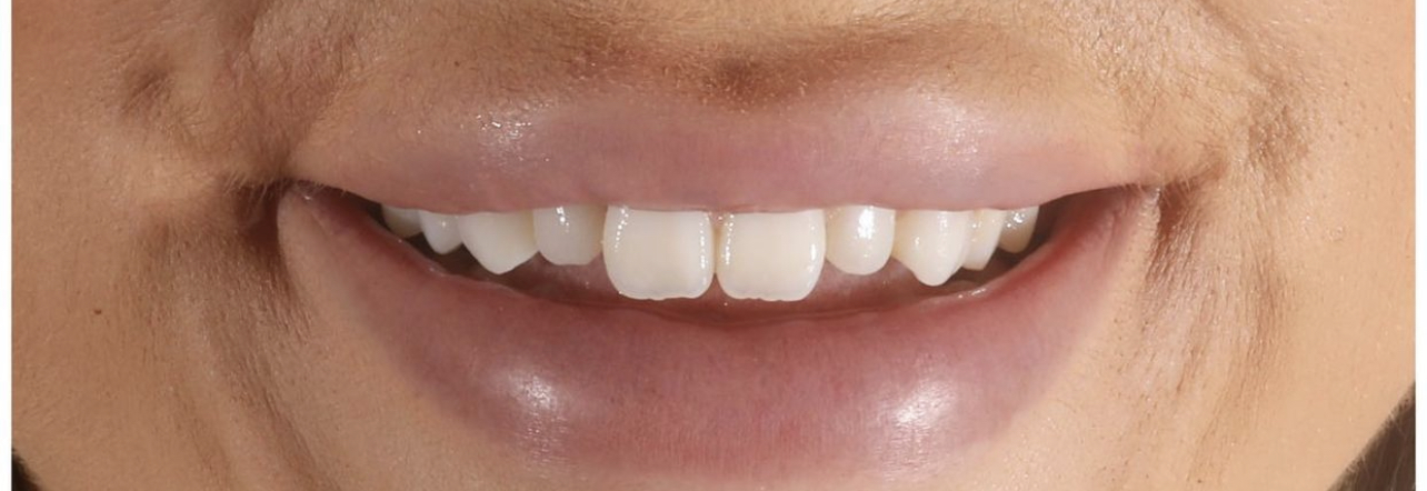Lengthening short second teeth with Composite Bonding