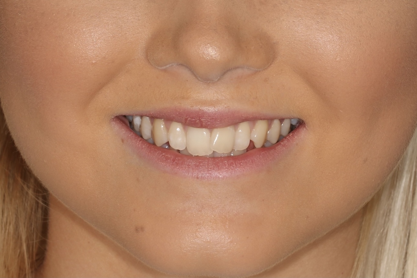 Correcting overlapping front teeth