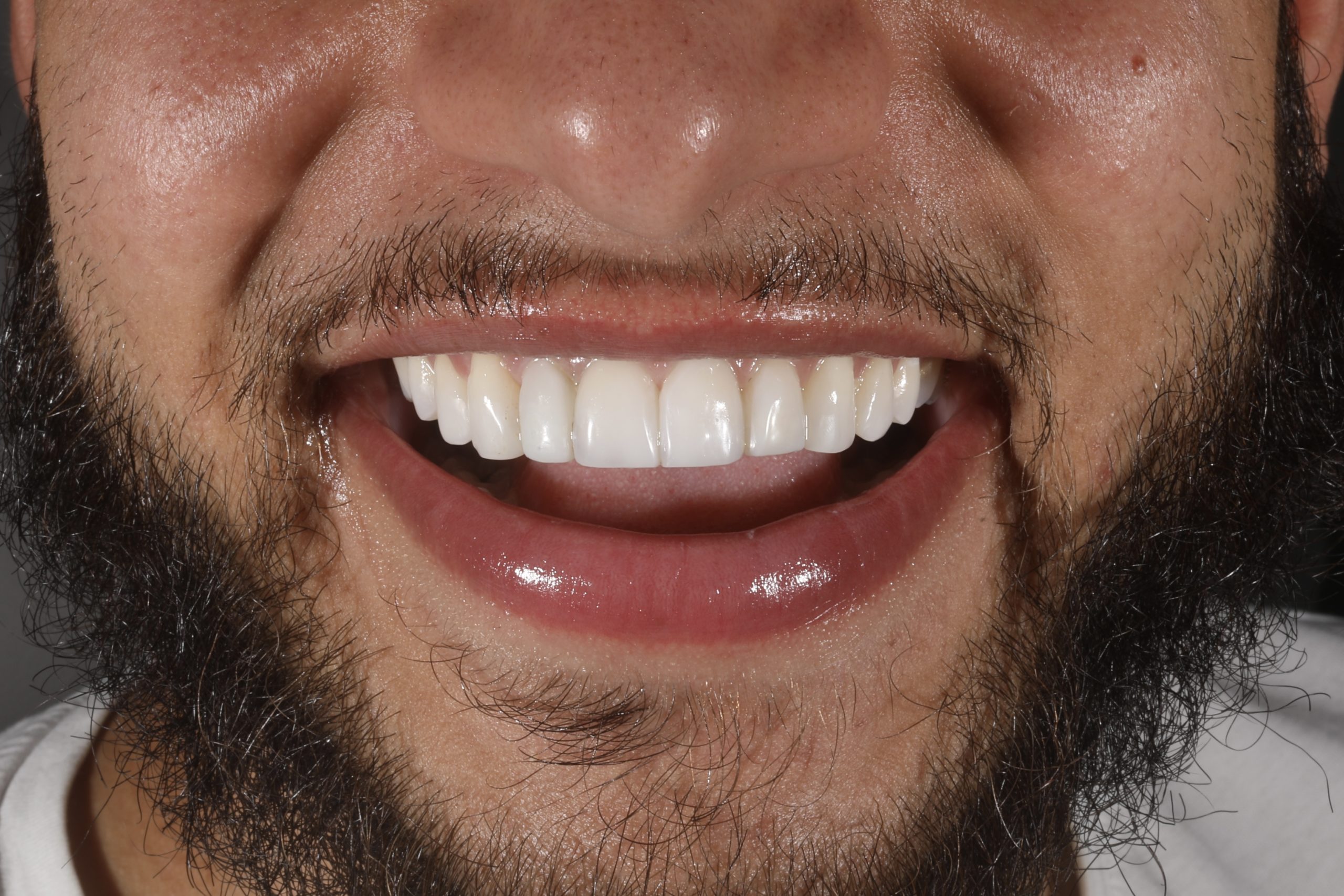 Creating a neater smile with composite edge bonding