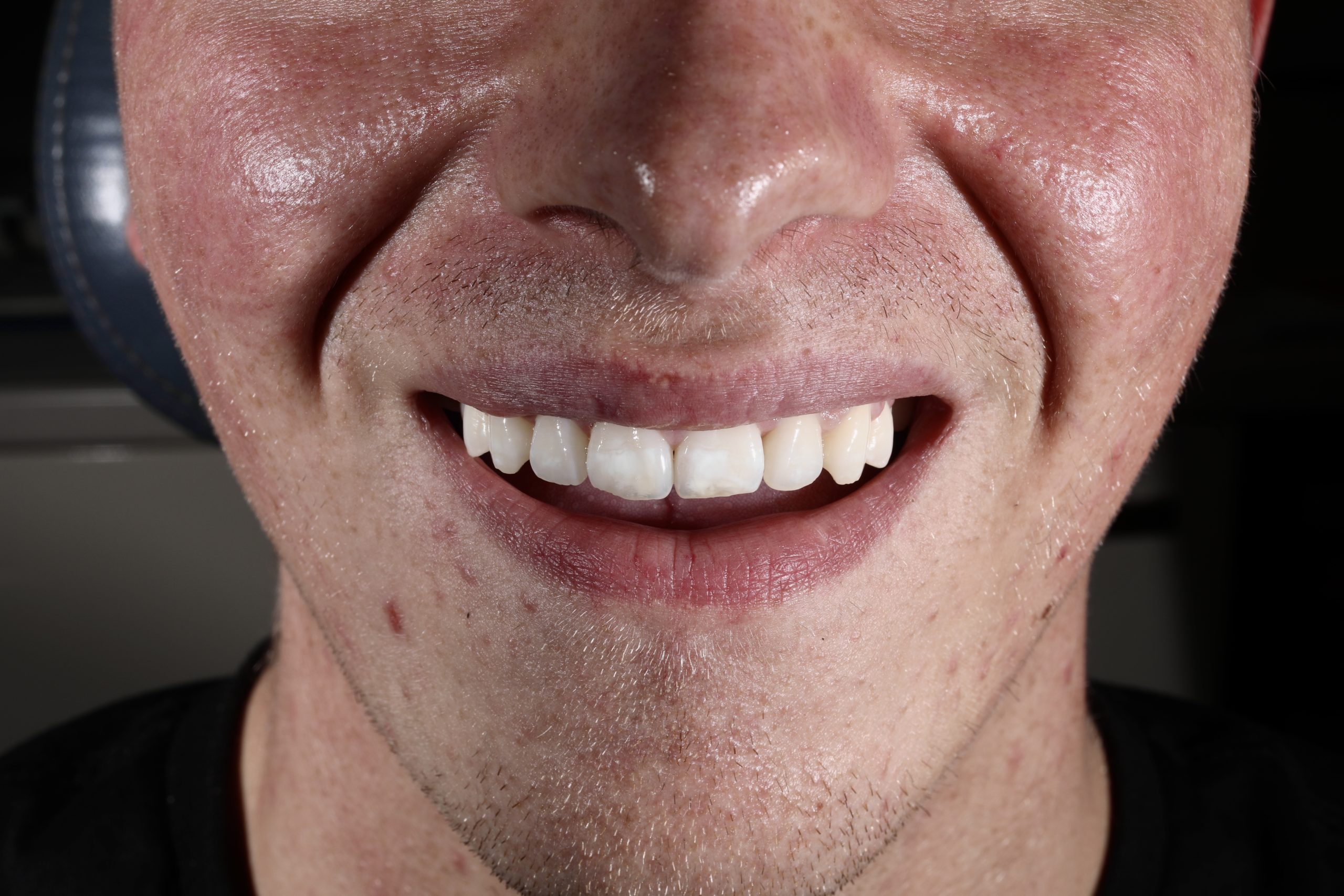 Covering patchy teeth with Direct Composite Veneers