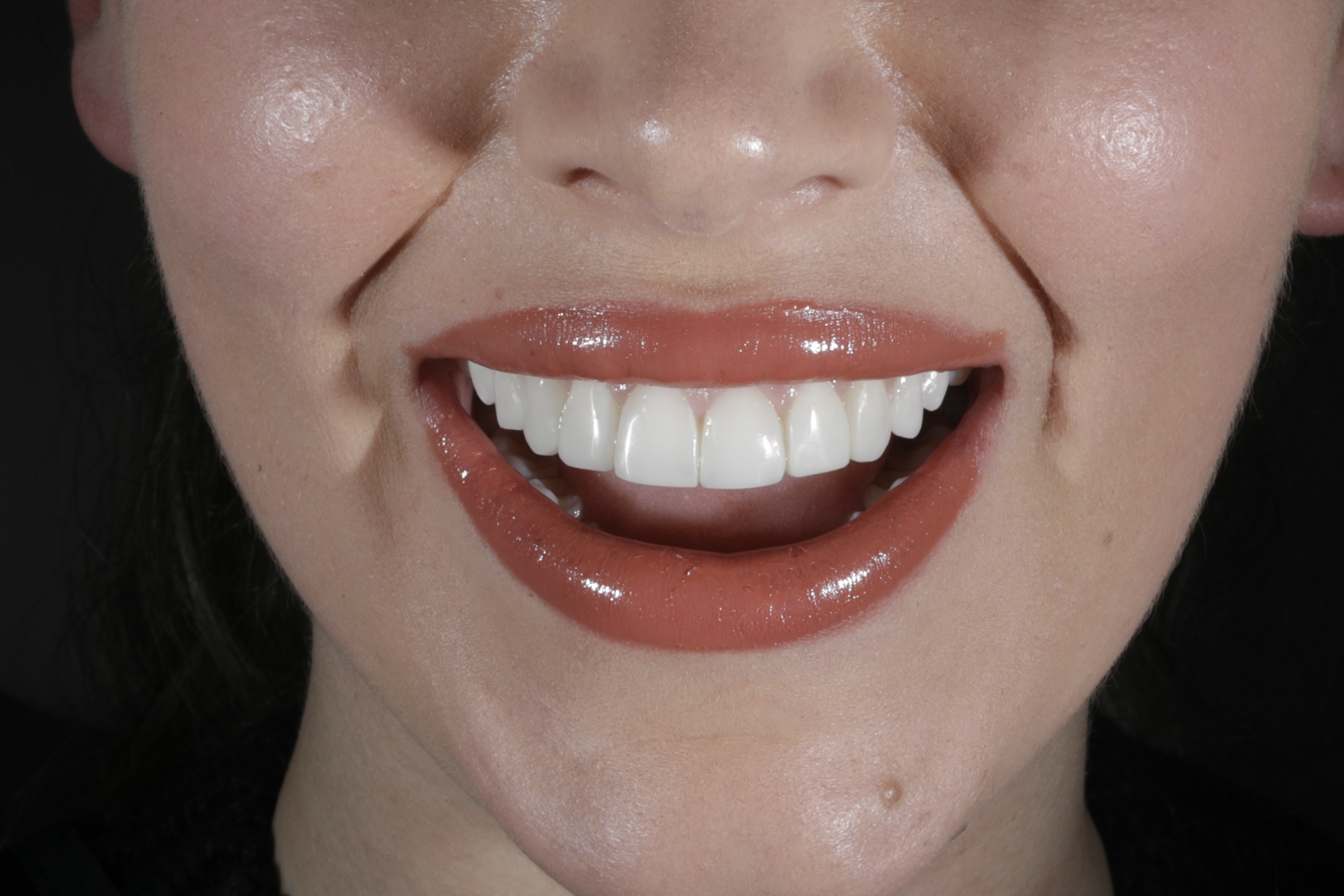 8 Teeth Composite Edge Bonding