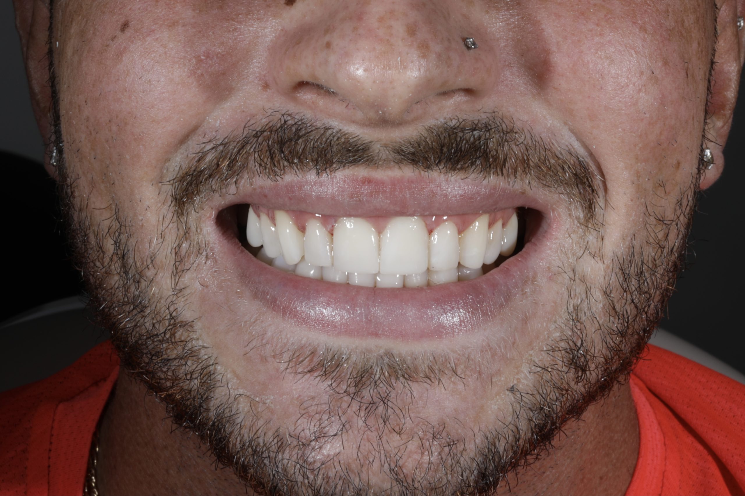 6 Teeth Composite Edge Bonding and 4 Composite Veneers to create a more even, wider smile
