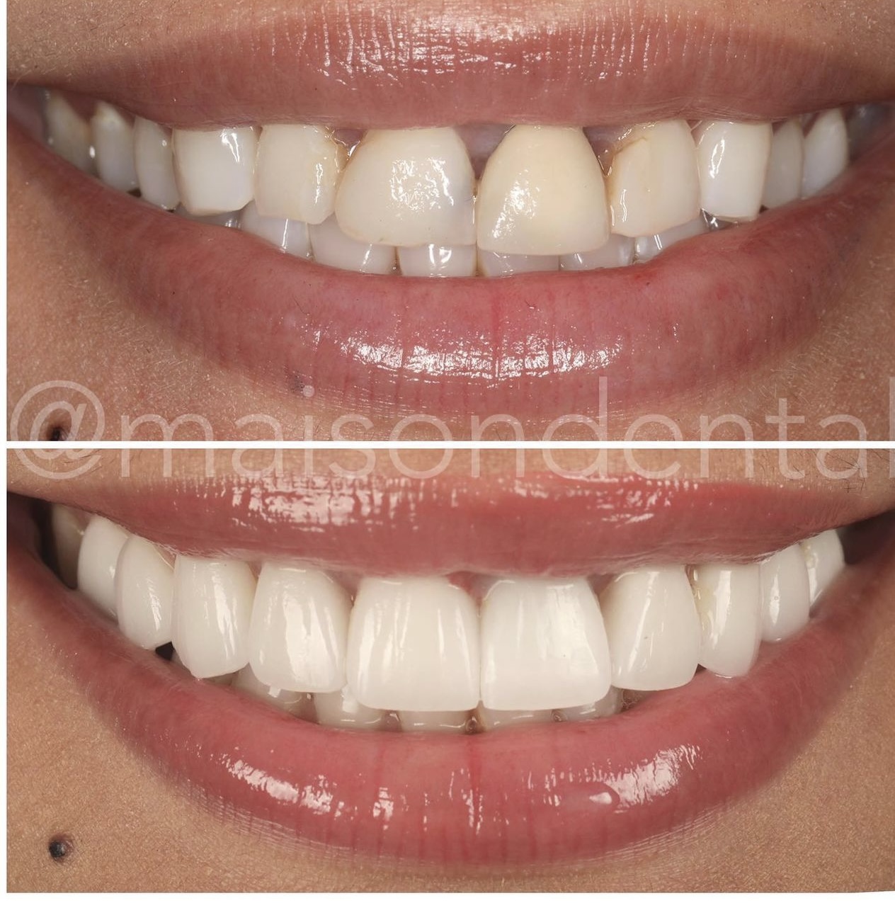 Restoring Broken Teeth, Correcting Alignment and Producing a Wider Brighter Smile
