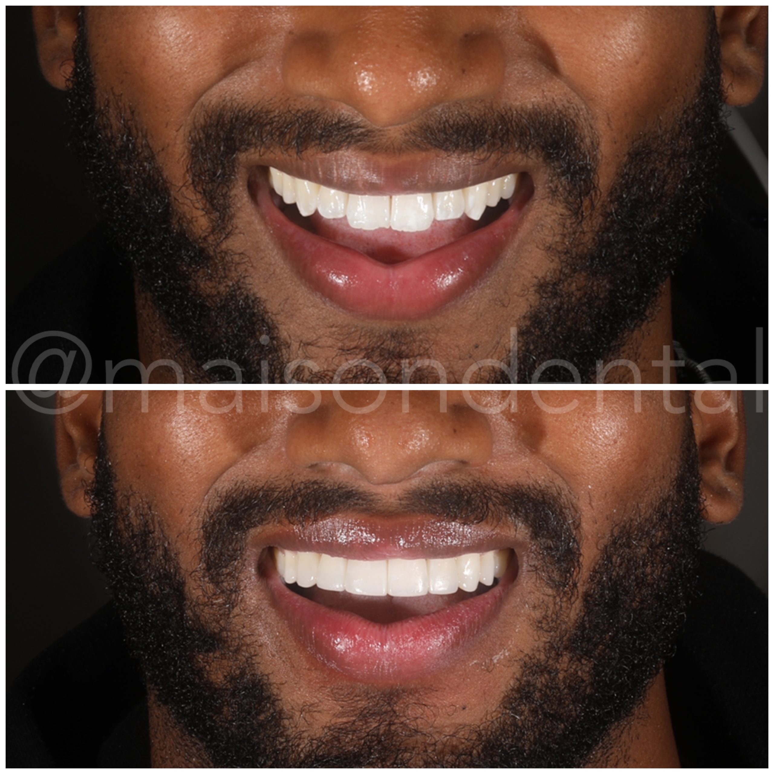 Creating Even Lengths of the Teeth and Producing an Overall More Symmetrical Smile