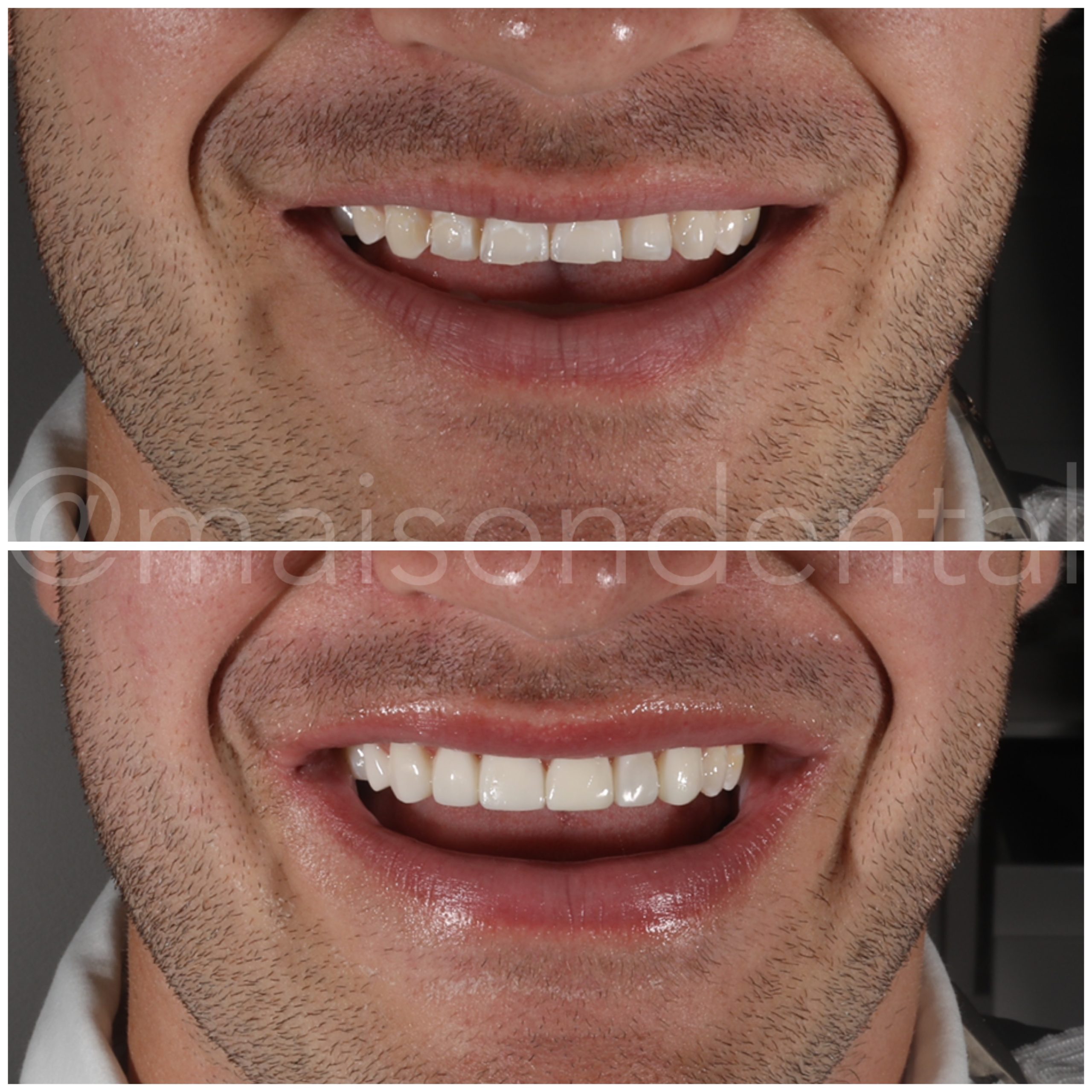 No Drilling Composite Veneers with our Predesigned Technique