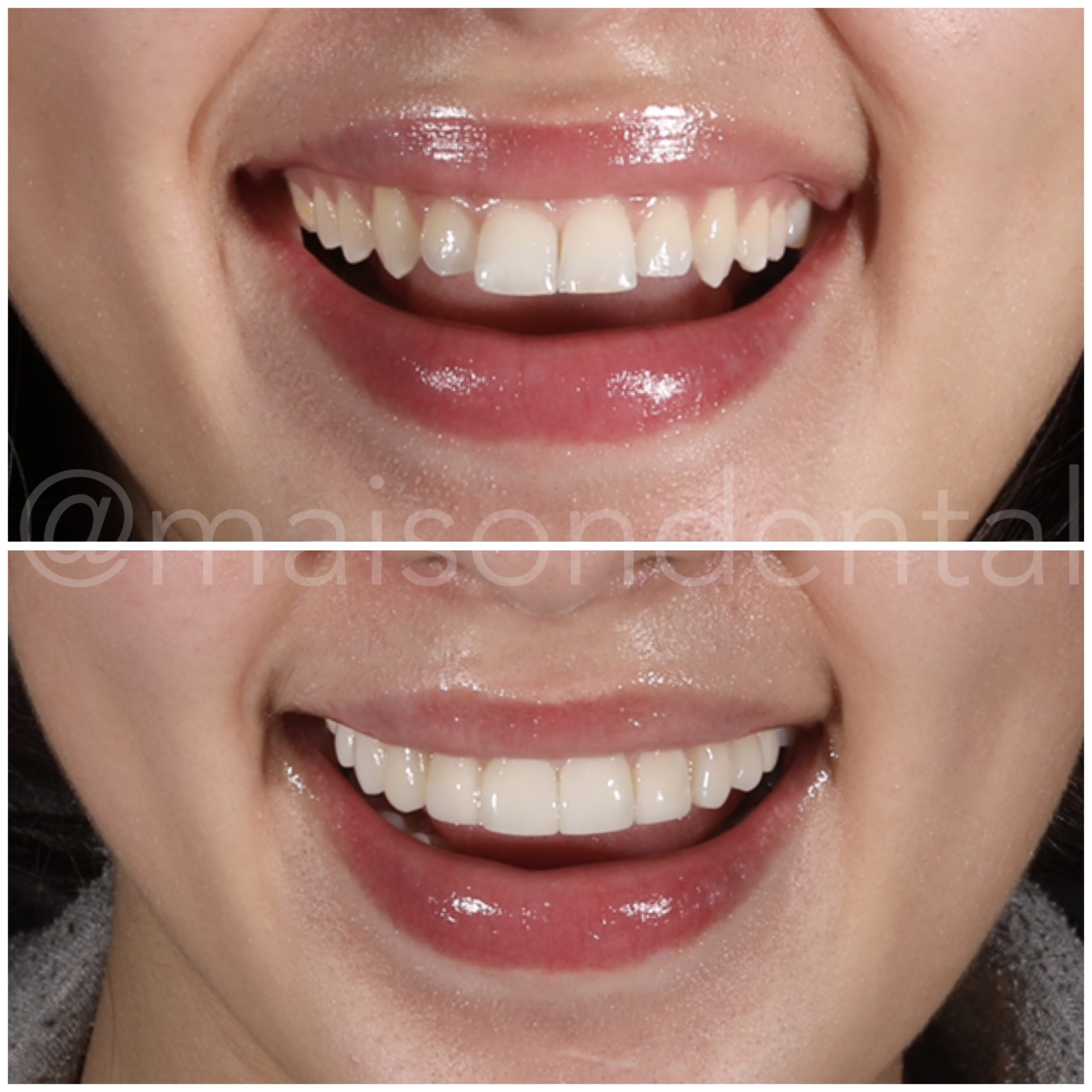 Creating a Brighter and Straighter Appearance of the Teeth with Composite Veneers