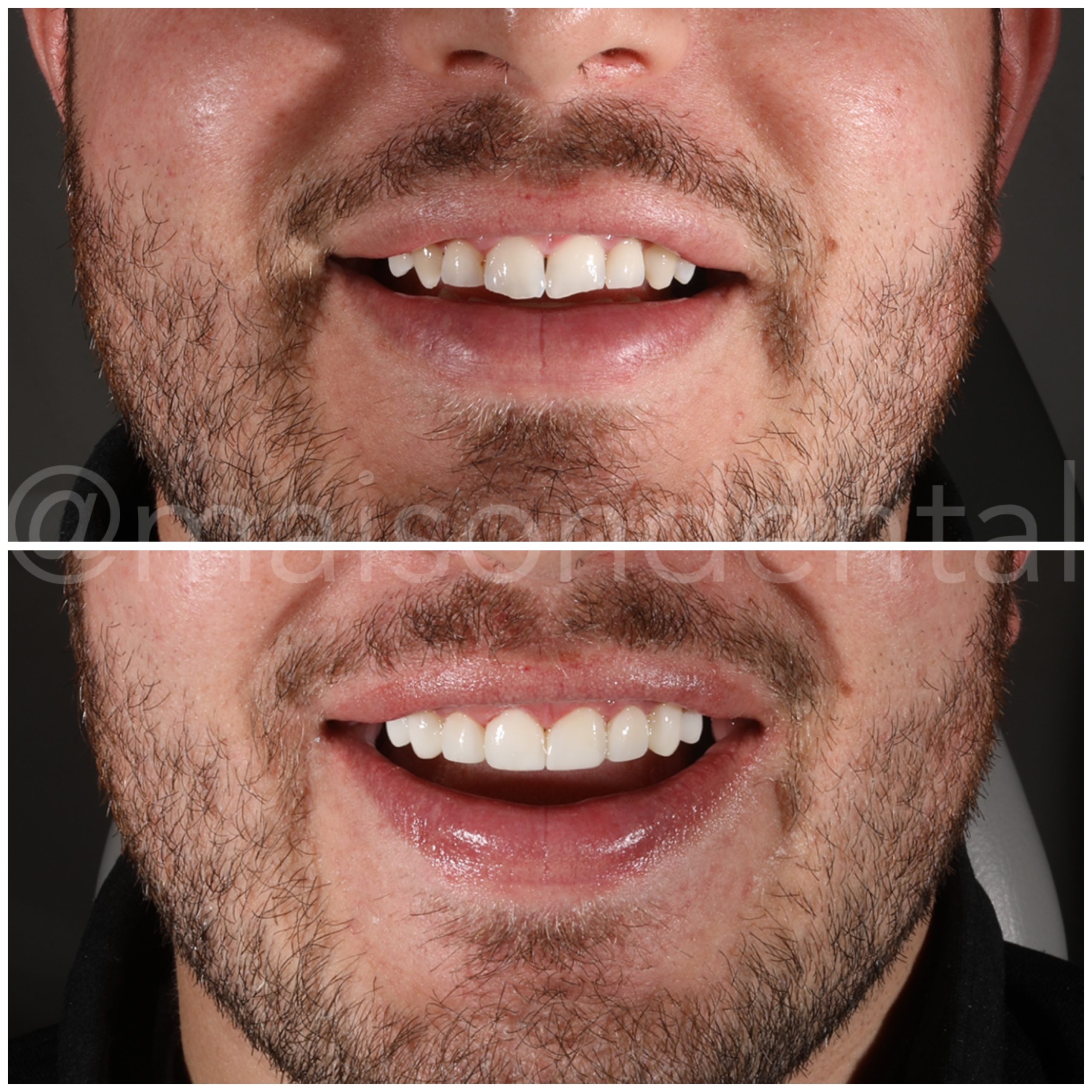 No Drilling Veneer Makeover