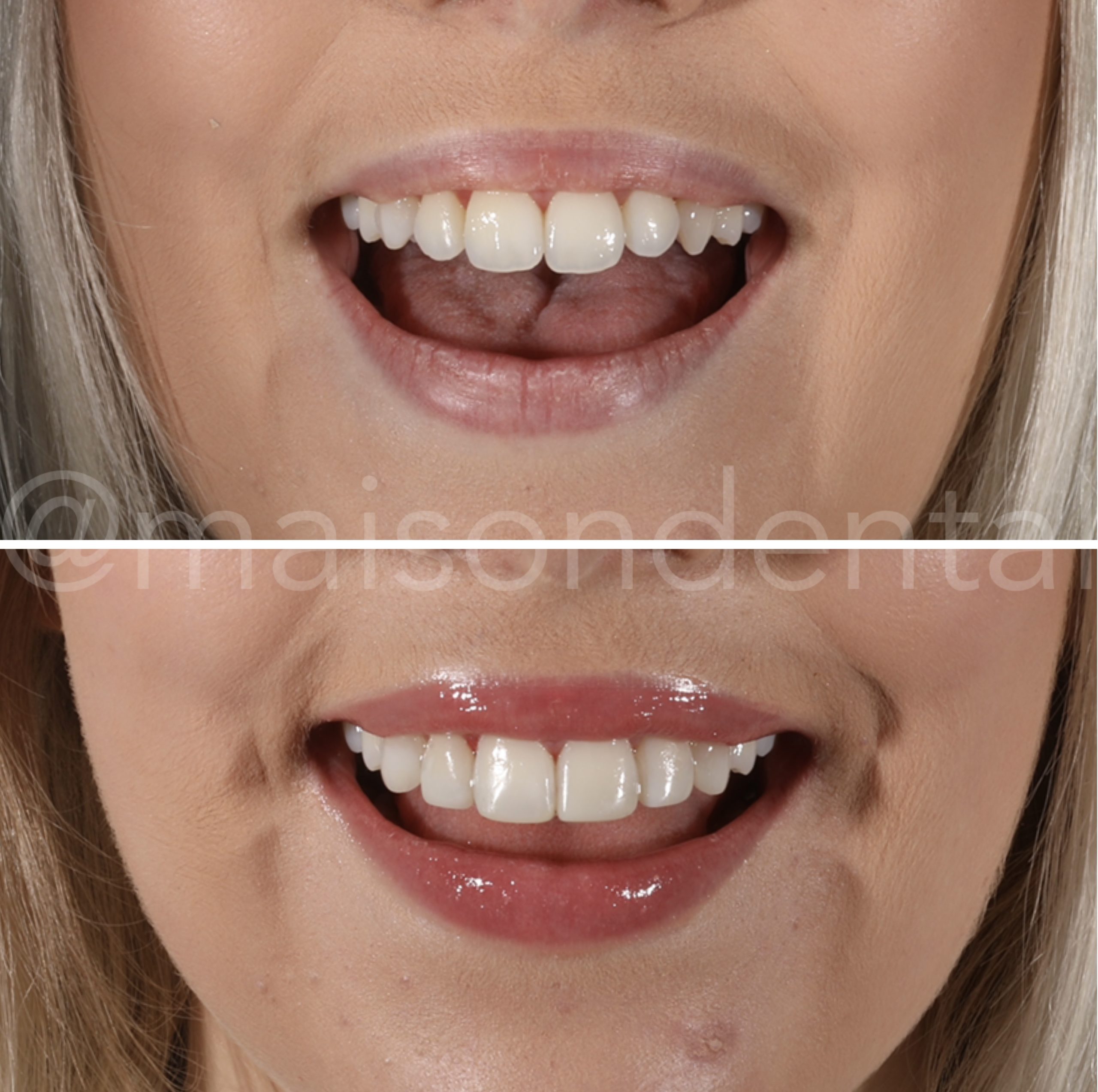 Composite Bonding to Produce a Less Rounded Appearance of the Teeth